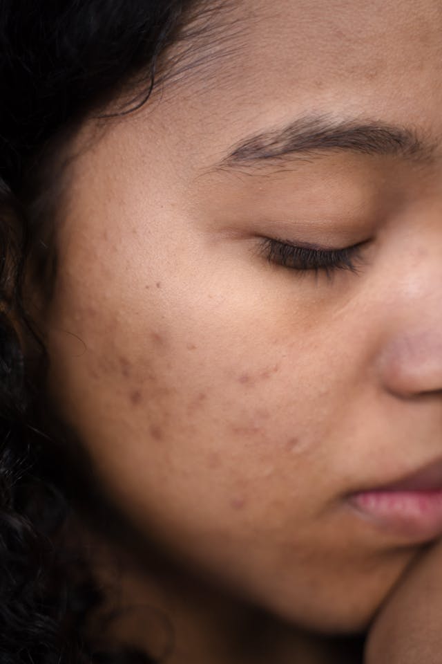 Woman with acne